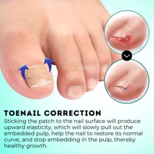 HealPatch™ Ingrown Toenail Corrector