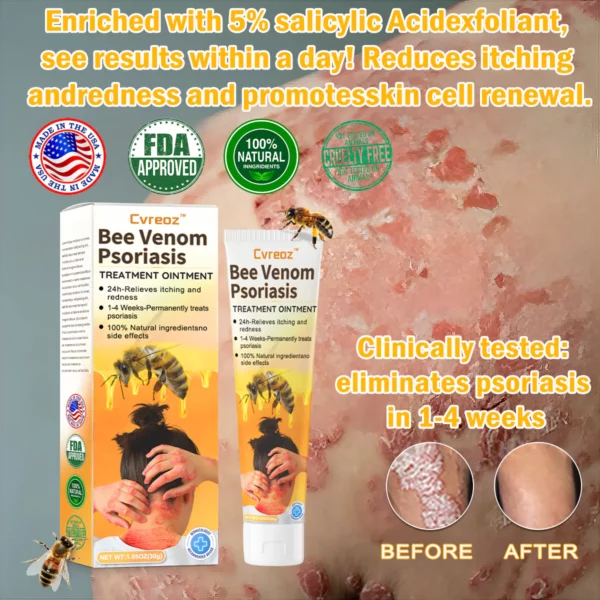 Cvreoz™ Bee Venom Psoriasis Treatment Ointment