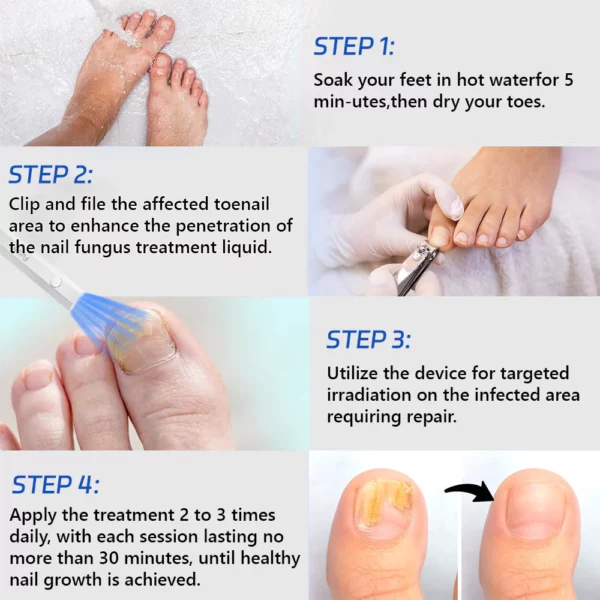 Furzero™ Toenail Fungus Laser Treatment Devices - Buy Today 75% OFF ...